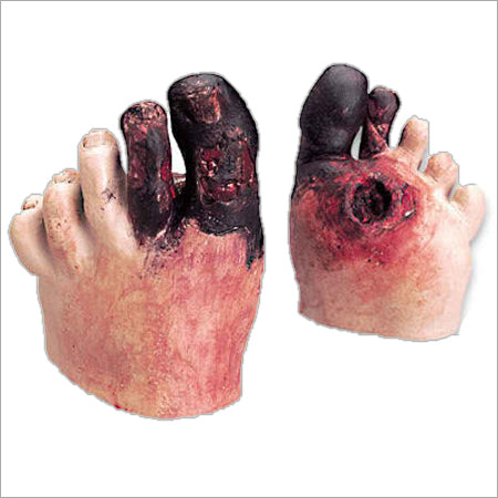 Unhealthy Foot Model - Distal End Only